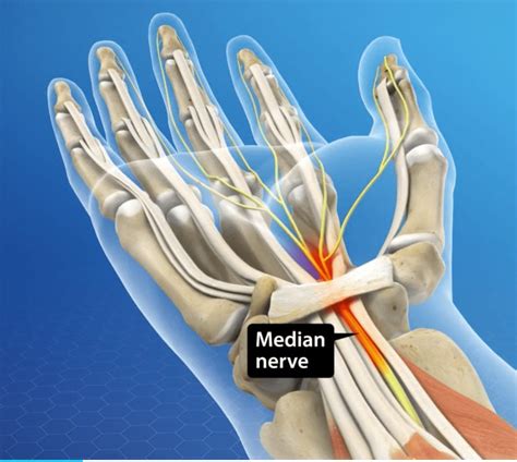 median nerve entrapment